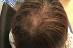 hair-in-recovery