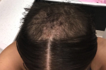 hair-in-recovery3